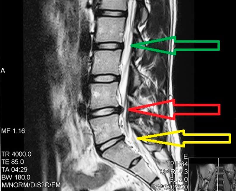 This is an MRI of a herniated disk. The photo shows a herniated disk in the lower back. The photo specifically shows three areas of disk herniations with green, red and yellow arrows.